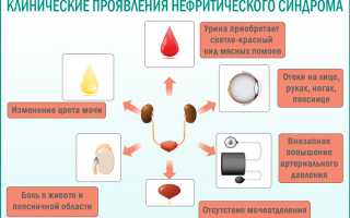 Нефро и нефритический синдромы отличия