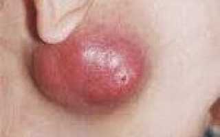 Опухоль околоушной области мкб код