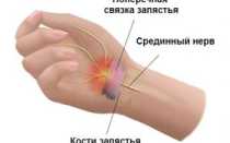 Синдромом запястного канала у беременных