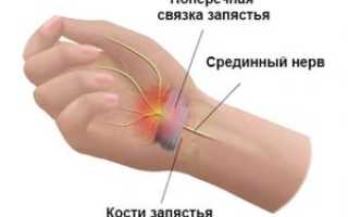 Лечение туннельного синдрома запястья при беременности