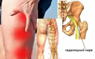Чем снять болевой синдром при ишиасе