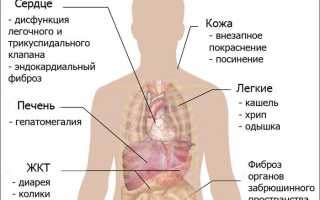 Карциноидный синдром и карциноидная опухоль фото
