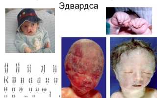 Ребенок с синдромом эдвардса фото