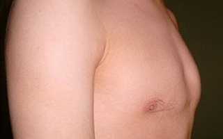 Деформация грудины код мкб