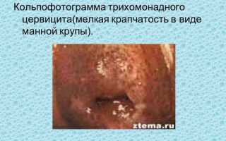 Синдром манной крупы как проявление панкреатита