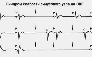 Экг признаки синдром слабости синусового узла