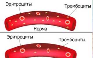Тромбоцитопения неуточненная код мкб