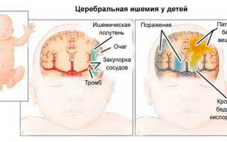 Что такое церебральная ишемия с гипертензионным синдромом