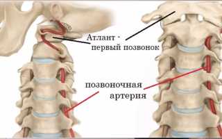 Что такое умеренный болевой вертеброгенный синдром