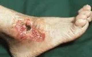 Код мкб трофическая язва культи