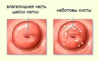 Ovuli naboti код мкб 10