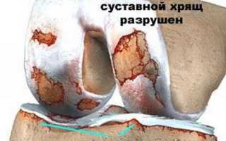 Лечение болевого синдрома при гонартрозе