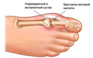 Подагра мкб 10 код