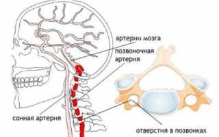 Синдром головная боль при остеохондрозе