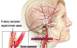 Дэп 2 степени вестибулярный синдром что это