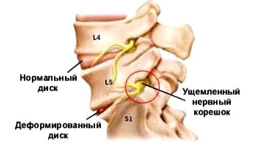Остеохондроз шейного отдела с корешковым синдромом лечение