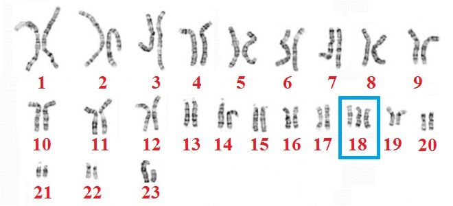 синдром эдвардса причины