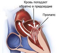 Малые аномалии развития сердца