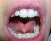 Короткая уздечка языка у ребенка