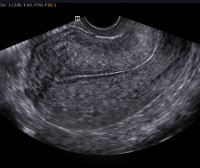 Рубец на матке