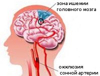 I65.2 Закупорка и стеноз сонной артерии