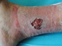 Трофическая язва