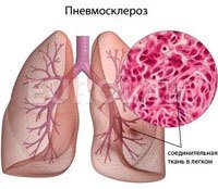 Пневмосклероз