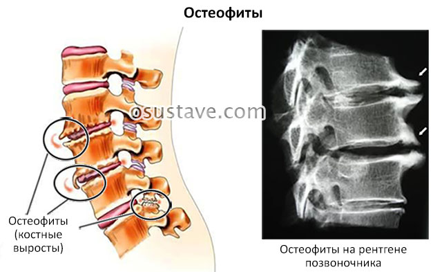 остеофиты на позвонках
