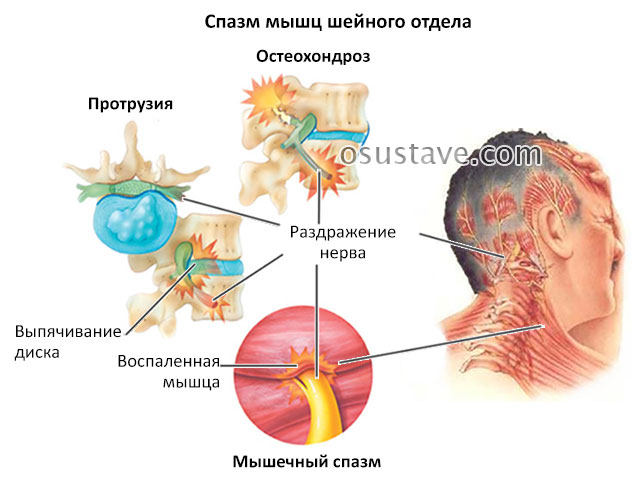 спазм мышц шейного отдела