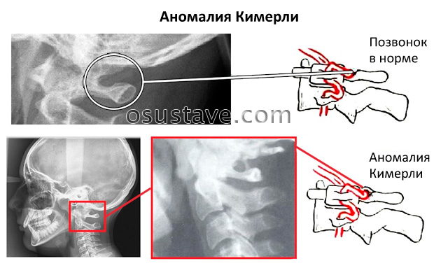 аномалия Кимерли