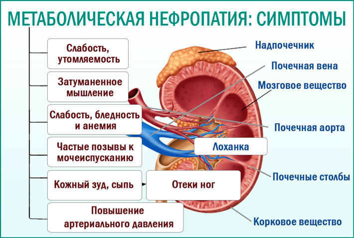 Симптомы метаболической нефропатии