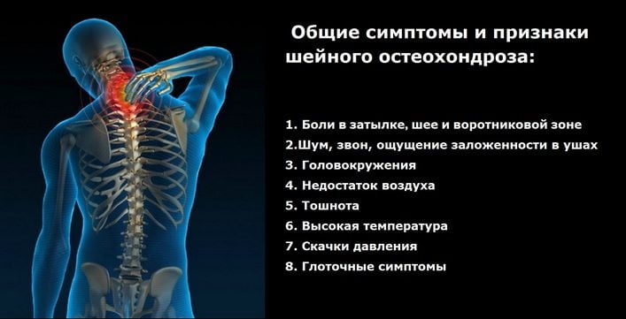 Остеохондроз шейного отдела с корешковым синдромом лечение