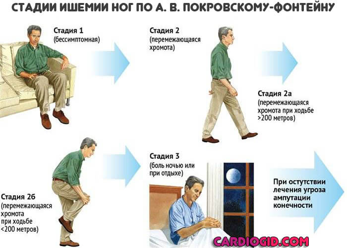 Стадии ишемии ног по А. В. Покровскому-Фонтейну