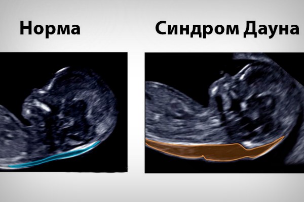 УЗИ болезнь Дауна