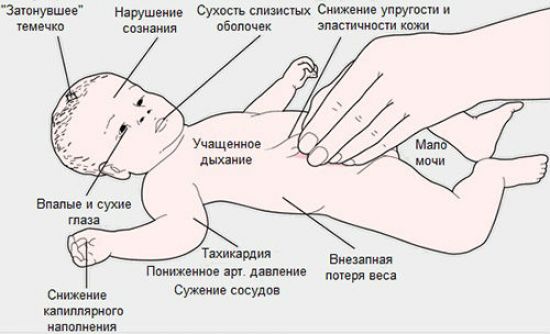 Андрогенитальный синдром