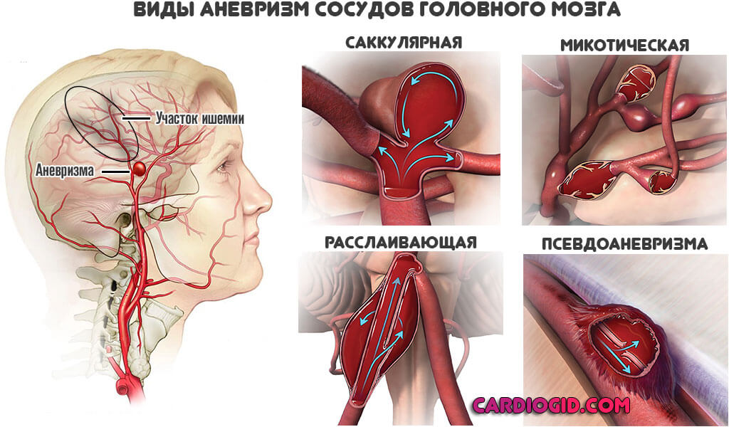аневризма-сосудов-мозга
