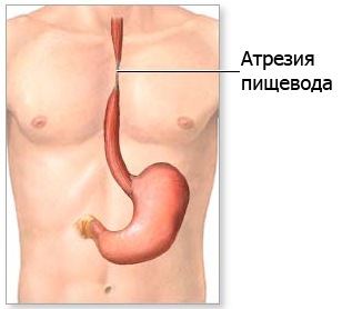 Атрезия пищевода