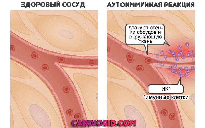 аутоиммунная-реакция