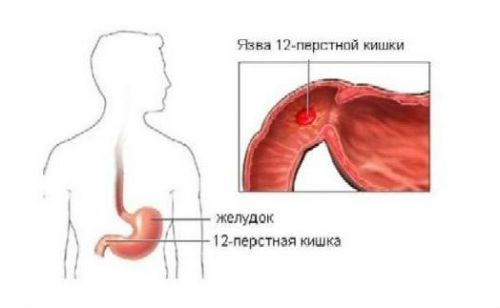 Язва 12-перстной кишки