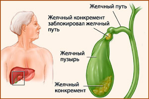 Образование в желчных протоках камней