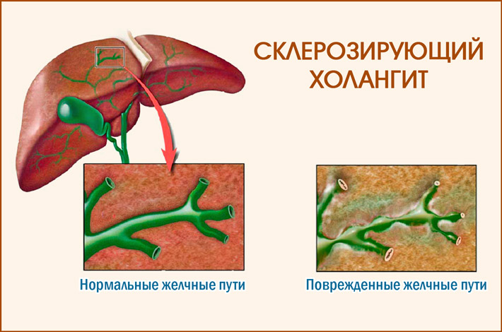 Склерозирующий холангит