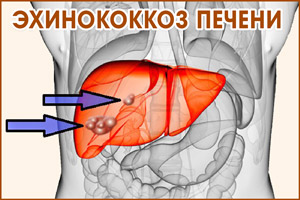 Эхинококкоз печени