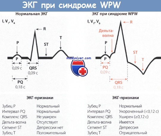 ЭКГ при синдроме Вольфа-Паркинсона-Уайта (WPW)