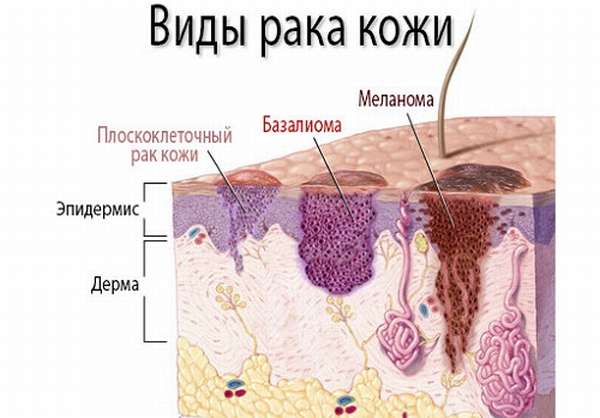Базалиома глаза код по мкб