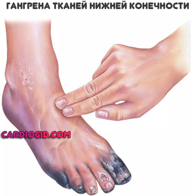 гангрена-тканей-ноги