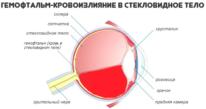 гемофтальм