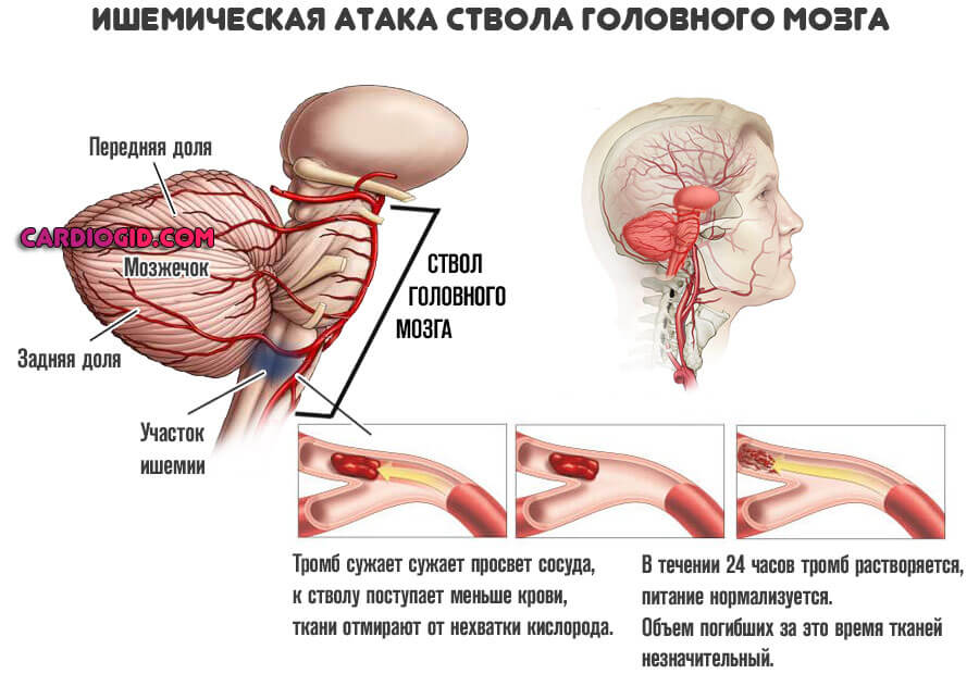 ишемическая-атака-ствола