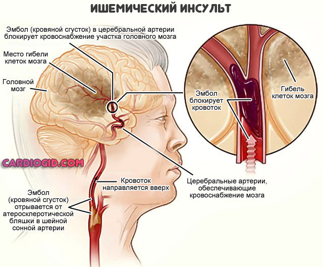 ишемический-инсульт