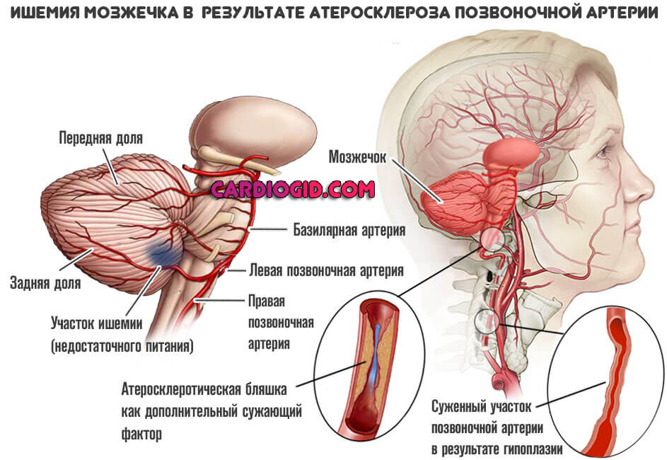 ишемия-мозжечка-в-результате-гипоплазии