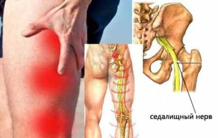 Боли при защемлении седалищного нерва 